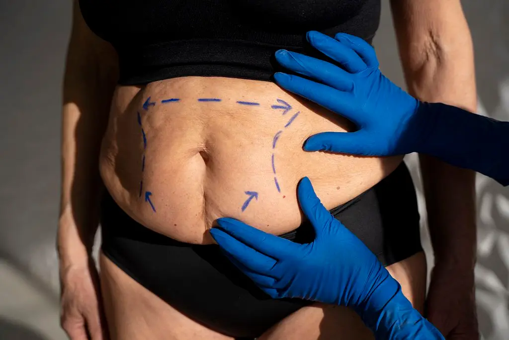 Cirurgia Plástica Reparadora após Bariátrica - Image by Freepik.com